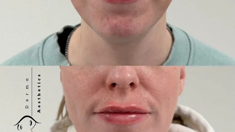 Polynucleotide skin regeneration treatment with a nurse at Perfectus Derma, Soho