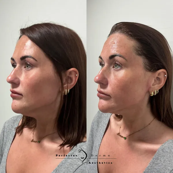 Real Results. One Treatment. Achieved after just one 90-minute Hydro2Facial.