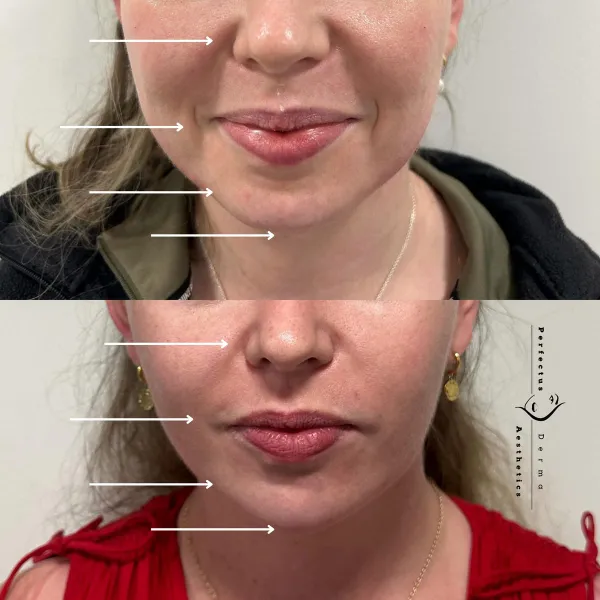Lower Face Balancing - Small refinements - Natural results.