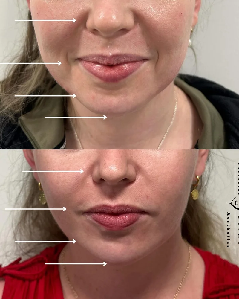 Lower face balancing: patient results