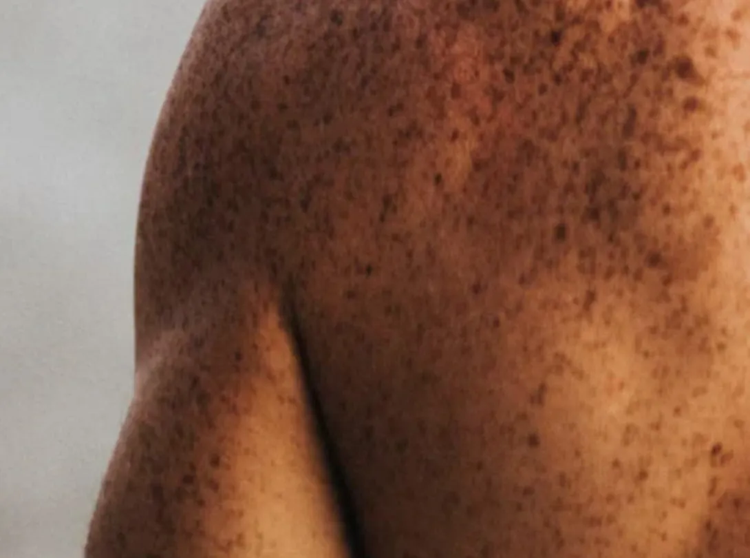 Fibromyalgia