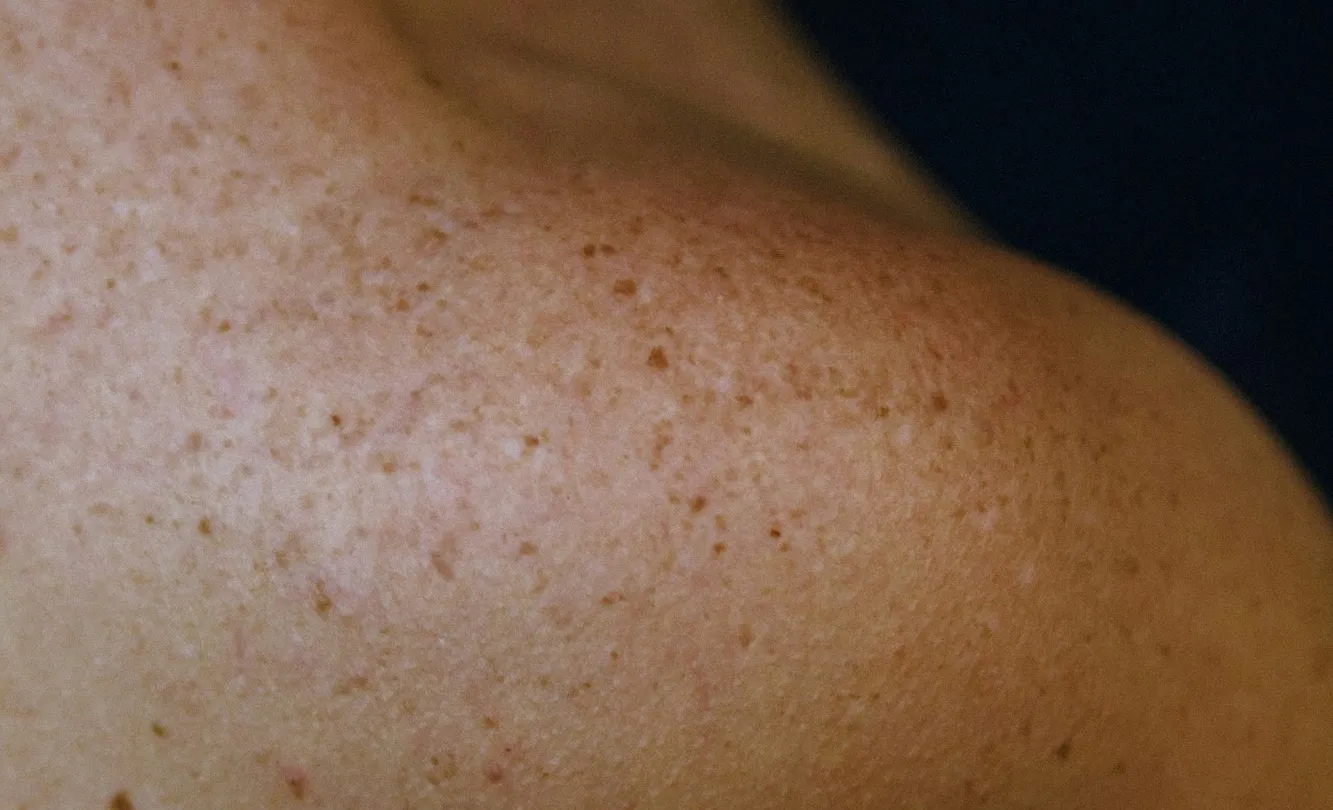 Perimenopause and menopause